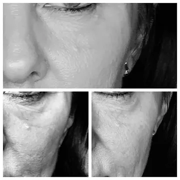 mezoterapia 1
