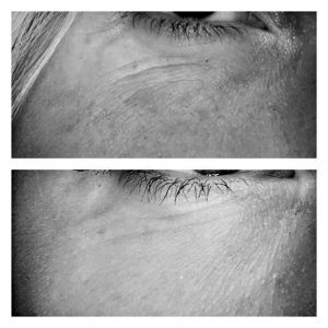 mezoterapia 2