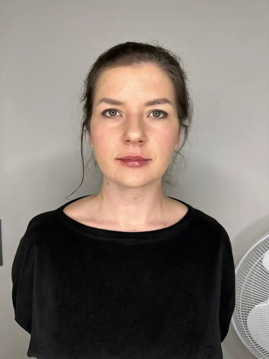 usta medycyna estetyczna Krakow - po