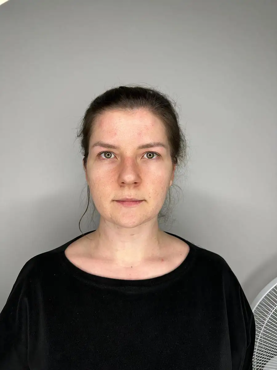 usta medycyna estetyczna Krakow - przed